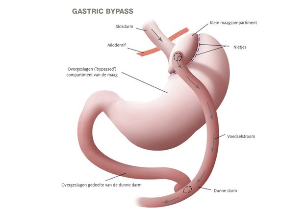 gastric bypass